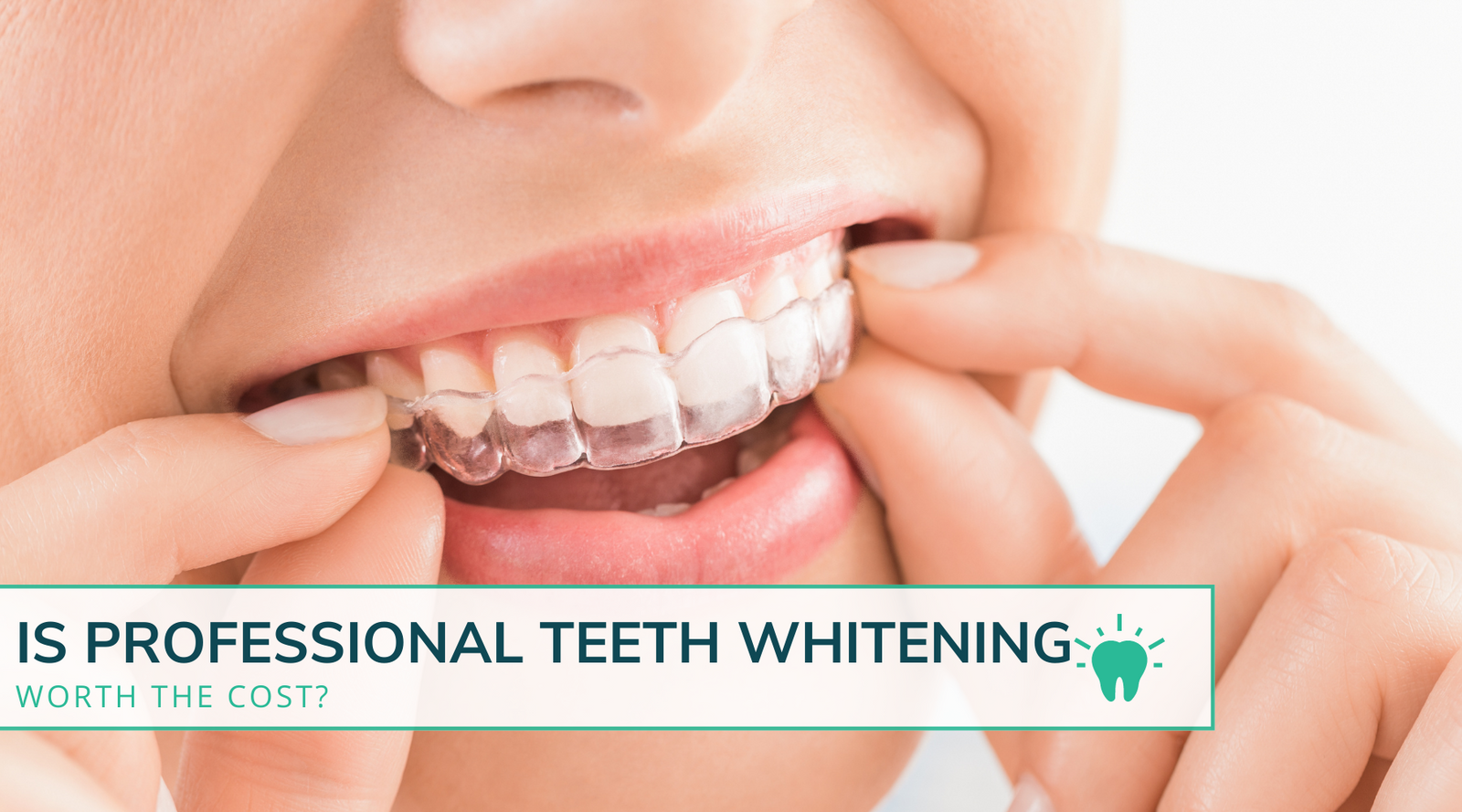 Is the Cost of Professional Teeth Whitening Worth It?