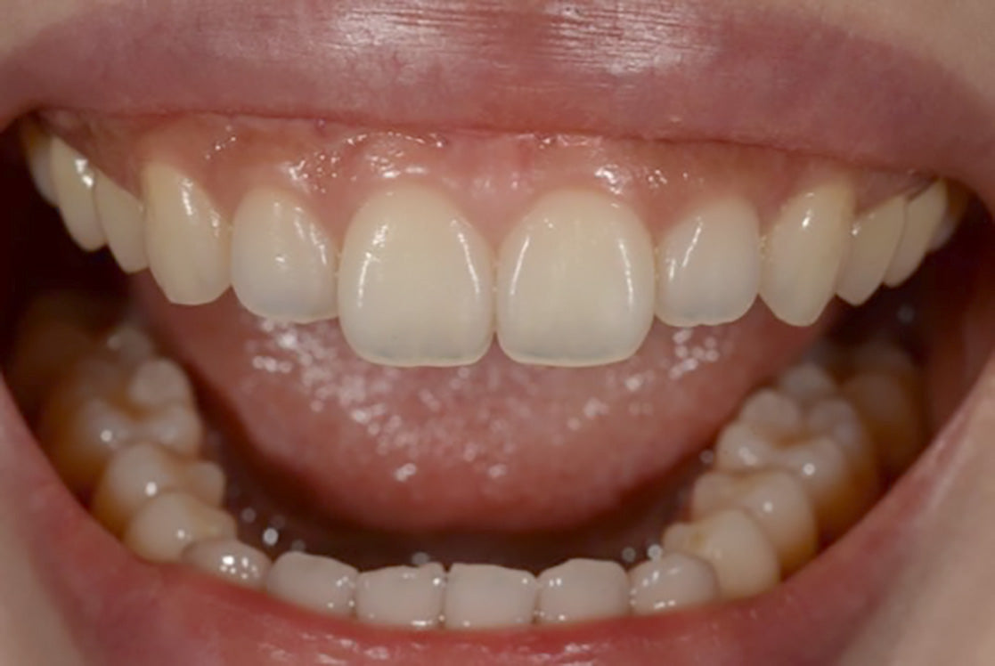 Close-up comparison — healthy opaque enamel edge vs. translucent, thinning edge