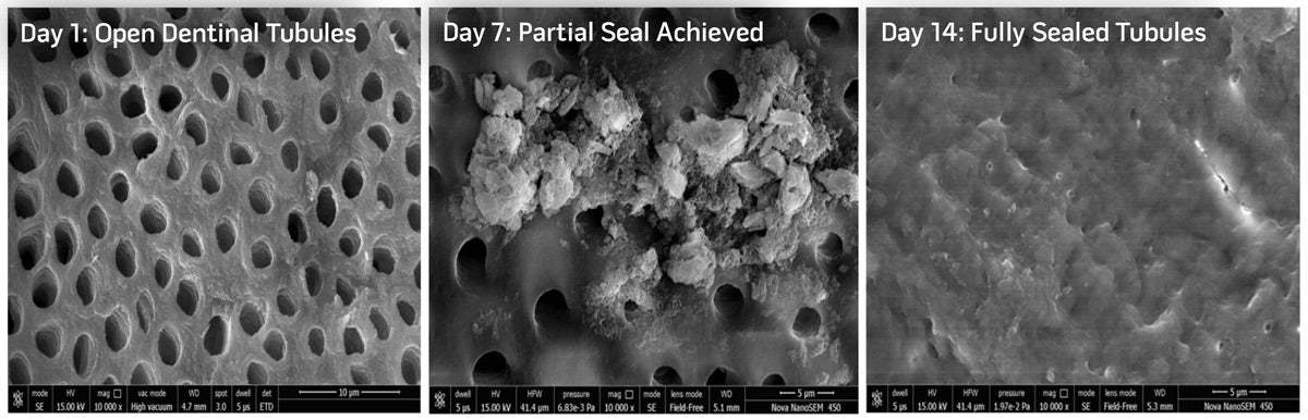 SEM images at 10,000x zoom showing nano-hydroxyapatite mineral deposition and tubule sealing